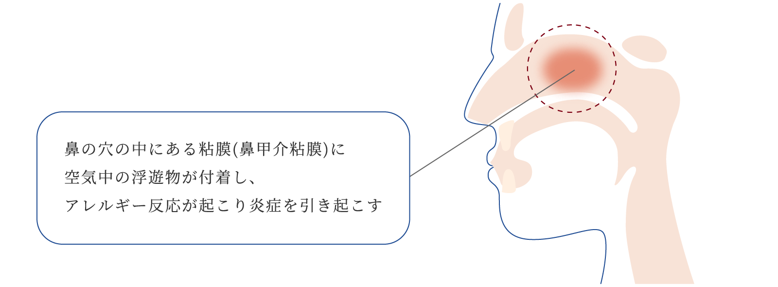 鼻アレルギーの仕組み