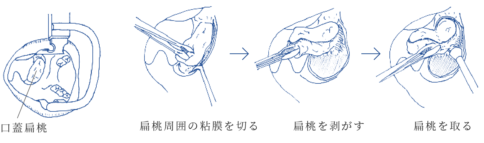 手術方法